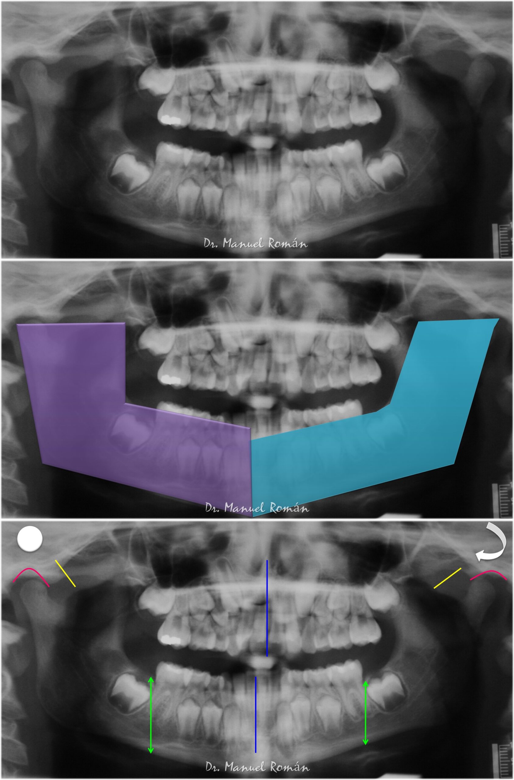 Tratamiento Precoz De La Mordida Cruzada Posterior Desde Los 4 Años En Dentición Temporal 3339