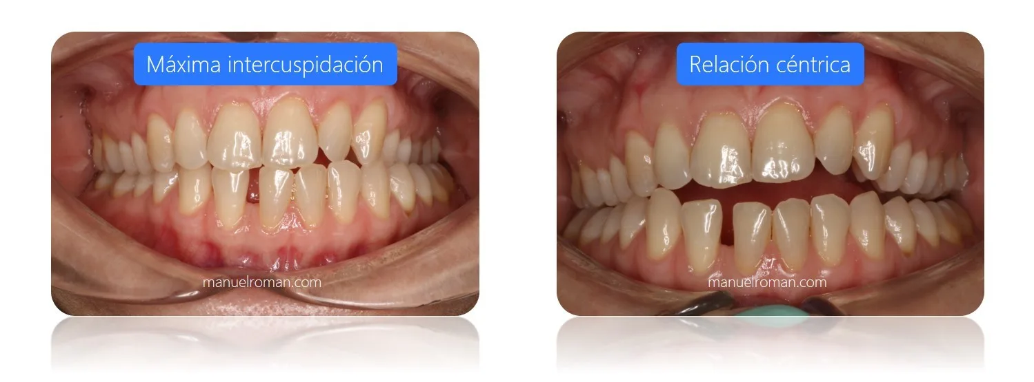 Relacion Centrica vs maxima intercuspidacion