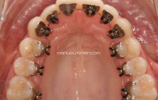 Ortodoncia lingual con arco recto
