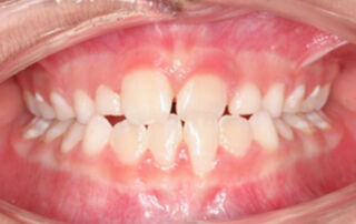 Caso clínico mordida cruzada anterior Pistas Composite – 01