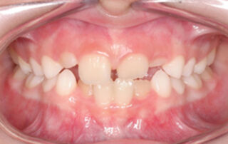 Caso clinico mordida cruzada anterior Quad Helix – 03