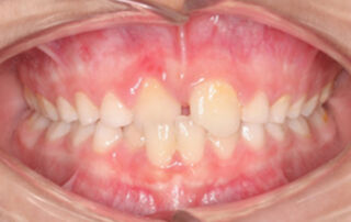 Caso clinico mordida cruzada anterior Brackets – 04