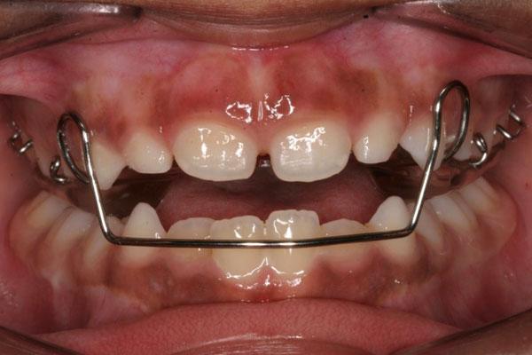 Aparatos de ortodoncia