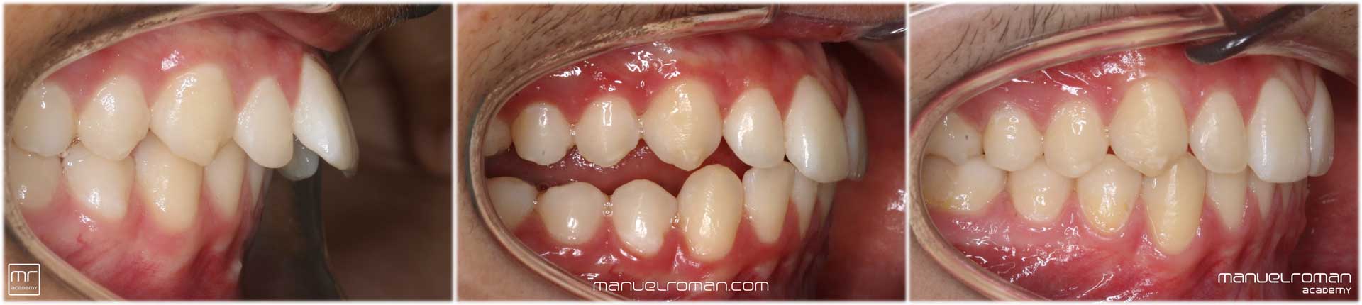 Clase II ortodoncia avance mandibular