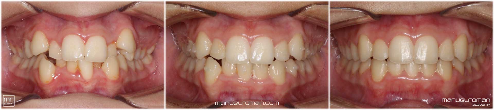 Experto extracciones ortodoncia