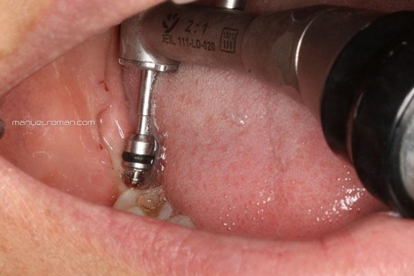 Colocación microtornillo en Ortodoncia