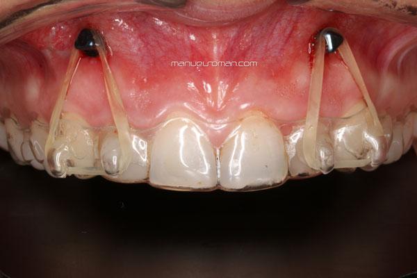 Microtornillos intrusion ortodoncia