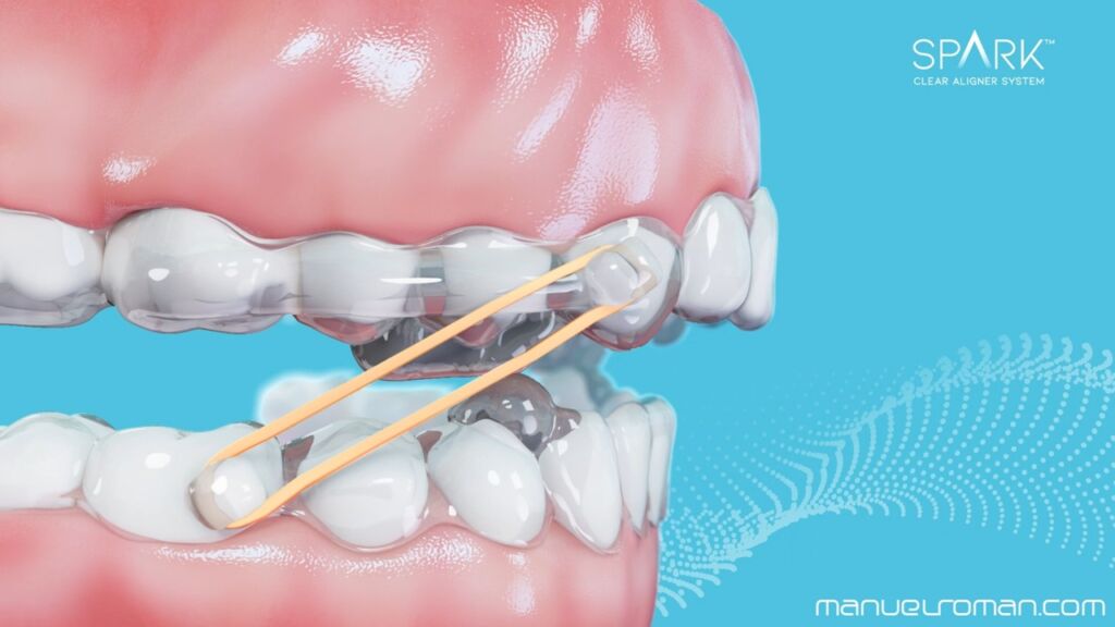 Spark BiteSync Avance Mandibular