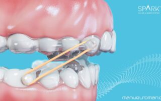 Spark BiteSync Avance Mandibular