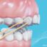 Spark BiteSync Avance Mandibular