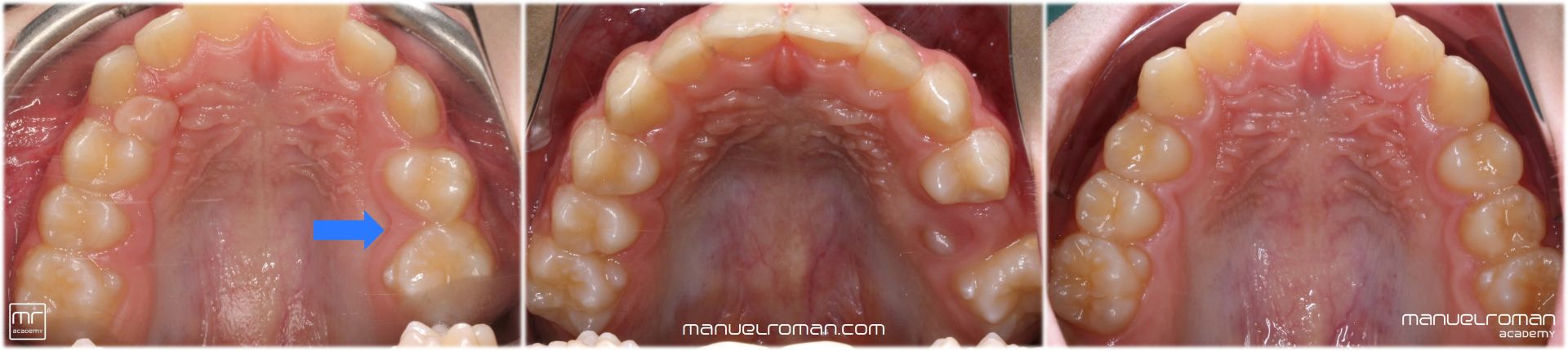 Dientes retenidos ortodoncia invisible Dientes retenidos ortodoncia invisible
