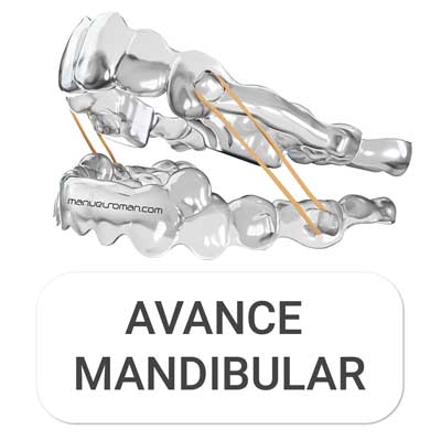 Masterclass Avance Mandibular