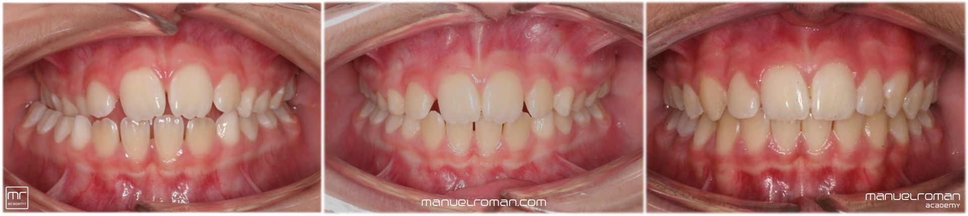 Mordida Cruzada Posterior Ortodoncia Invisible Mordida Cruzada Posterior Ortodoncia Invisible