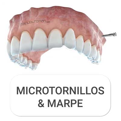 Masterclass Microtornillos alineadores Spark Invisalign
