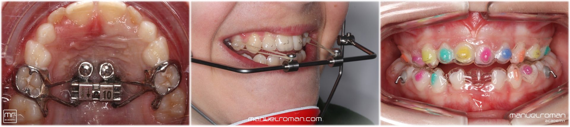 Invisalign Spark Angel Aligners Ortodoncia Invisalign Spark Angel Aligners Ortodoncia